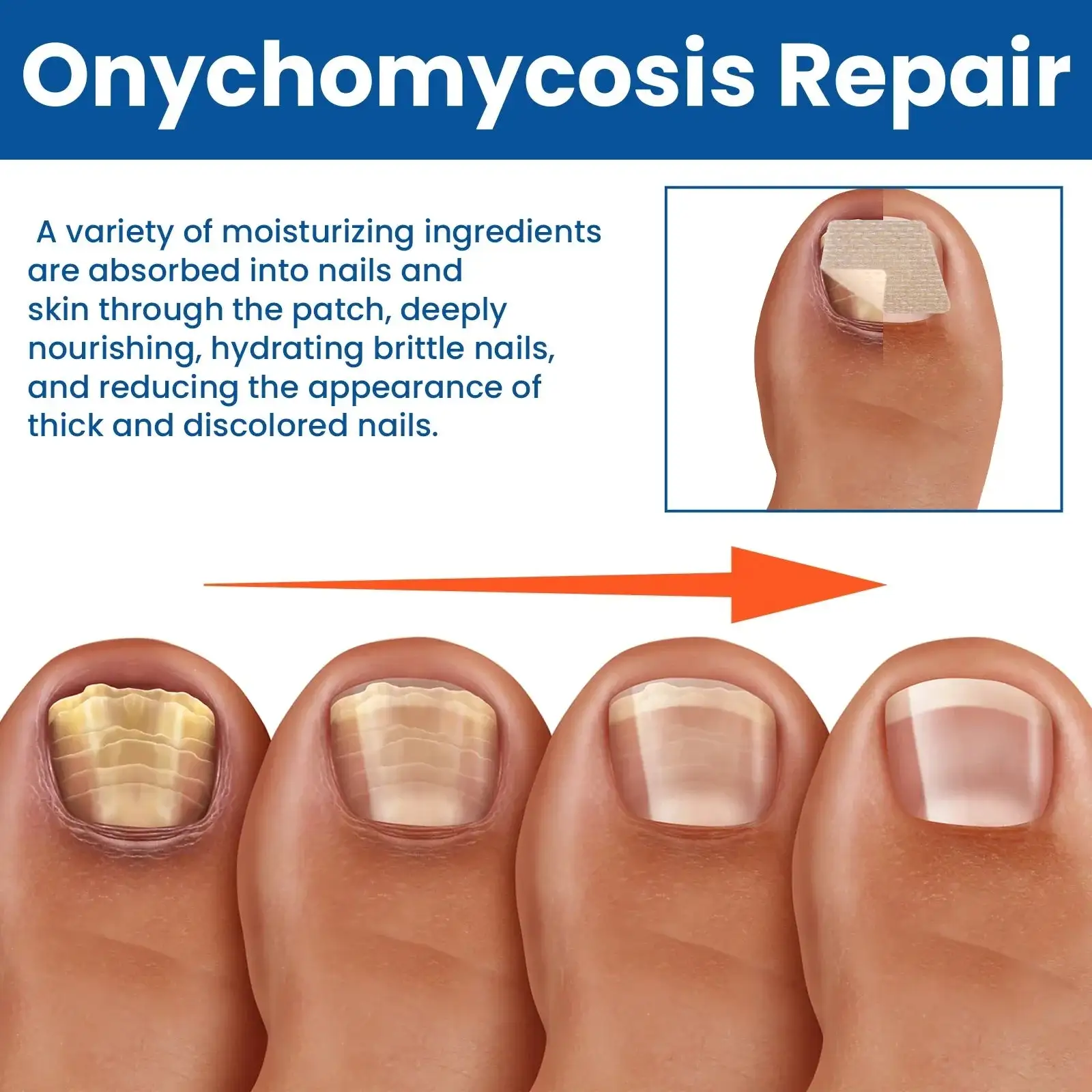 מדבקות לתיקון ציפורניים פטריות – תמונה 4