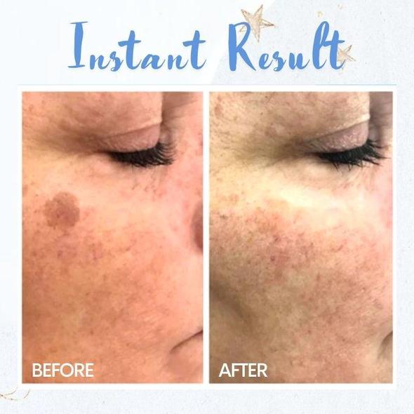 עט להסרת כתמים – תמונה 3