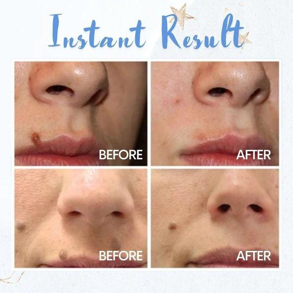 עט להסרת כתמים – תמונה 2